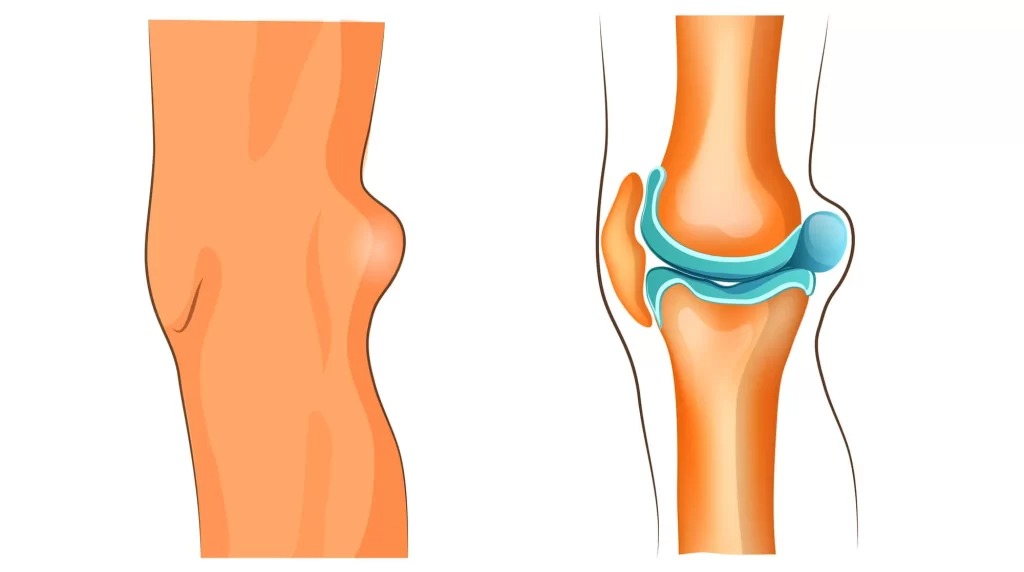 چگونه کیست بیکر را درمان کنیم؟