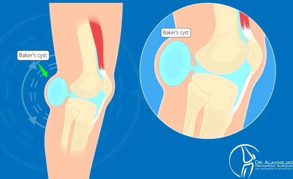 چگونه کیست بیکر را درمان کنیم؟