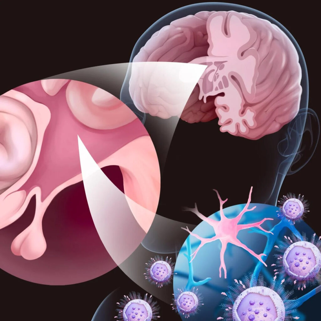 پژوهشگران دانشگاه کیندای کشف کردهاند که مصرف خوراکی آرژنین، یک اسید آمینه طبیعی، میتواند تجمع آمیلوئید بتا (Aβ) را مهار کرده و علائم عصبی را در مدلهای حیوانی بیماری آلزایمر کاهش دهد. یافتههای آنها، پتانسیل آرژنین را بهعنوان یک گزینه درمانی ایمن و مقرونبهصرفه برای آلزایمر و دیگر اختلالات نورودژنراتیو مرتبط با نادرستتاخوردگی پروتئینها برجسته میکند